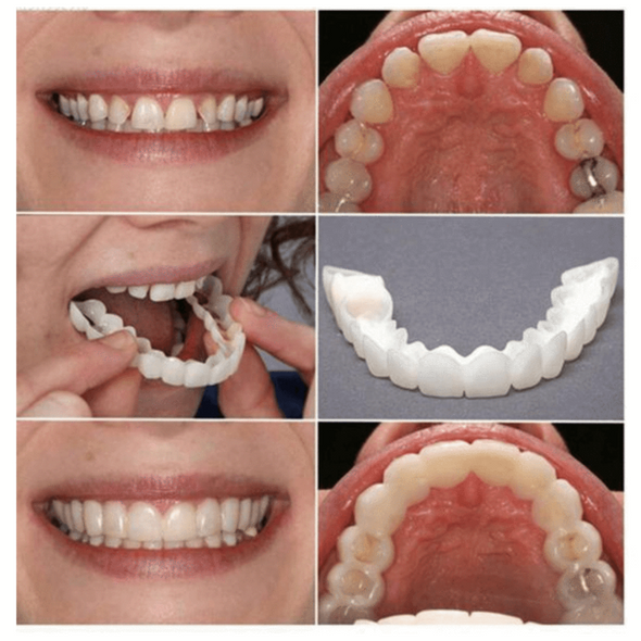 Perfect Smile Snap On Braces